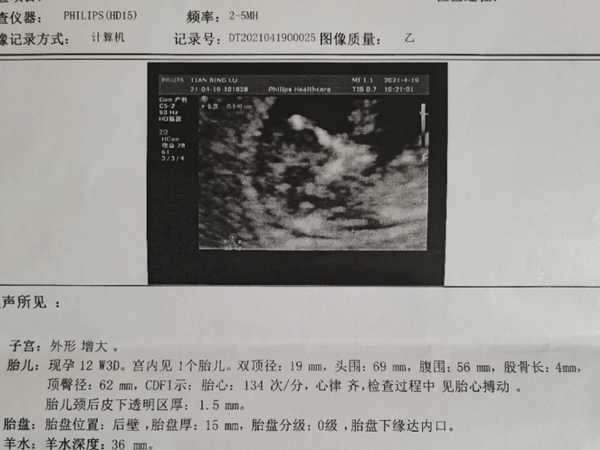 孕12周nt暗示胎儿性别？宝妈验证数值1.8是男孩还是女孩