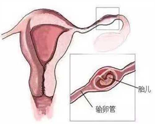 专业的代孕包性别哪里好_孕妇后期发烧对胎儿有影响吗