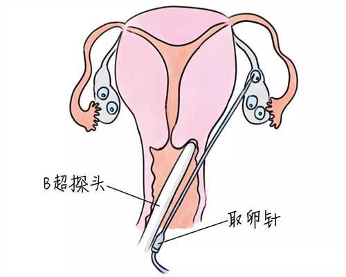 深圳人工代孕，深圳代孕去哪里最好，深圳做供卵试管有多大成功